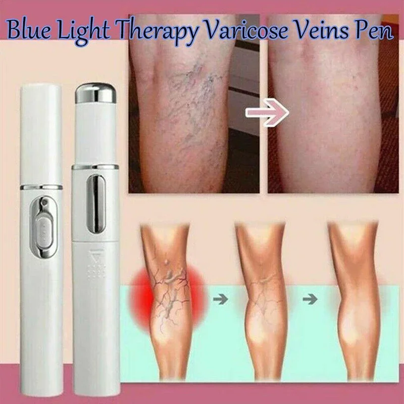 New Laser Therapy Keloid Scar  Blue Light Laser Pen White  Acne Removal Pen