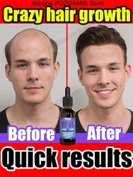 98% of buyers buy again, have more and more hair, say goodbye to baldness, thick hair,Hot selling product!