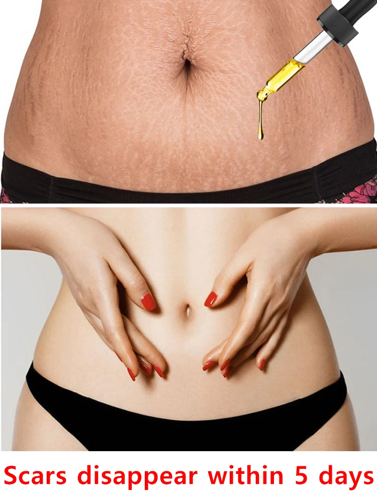 Body care lines An anti-stretch mark serum specifically designed for use during and after pregnancy; its potent, easily absorbed formula helps fade stretch marks and marks caused by rapid weight gain.