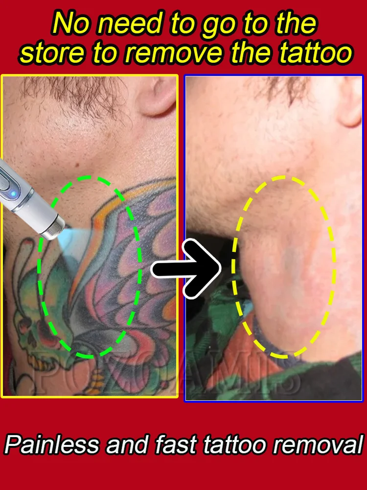 

Не нужно поезда в салон для удаления татуировок, безболезненных и без шрамов.