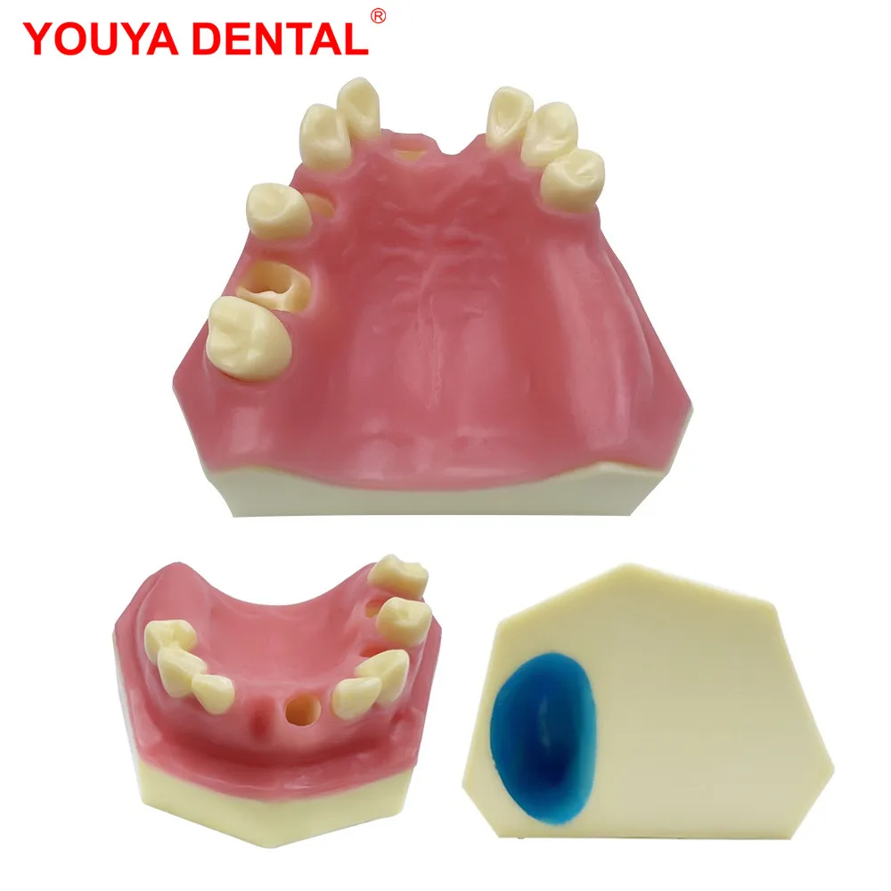 

Dental Implant Model Maxillary Sinus Missing Tooth Practice Teeth Model For Dental Students Dentist Studying Training Examation