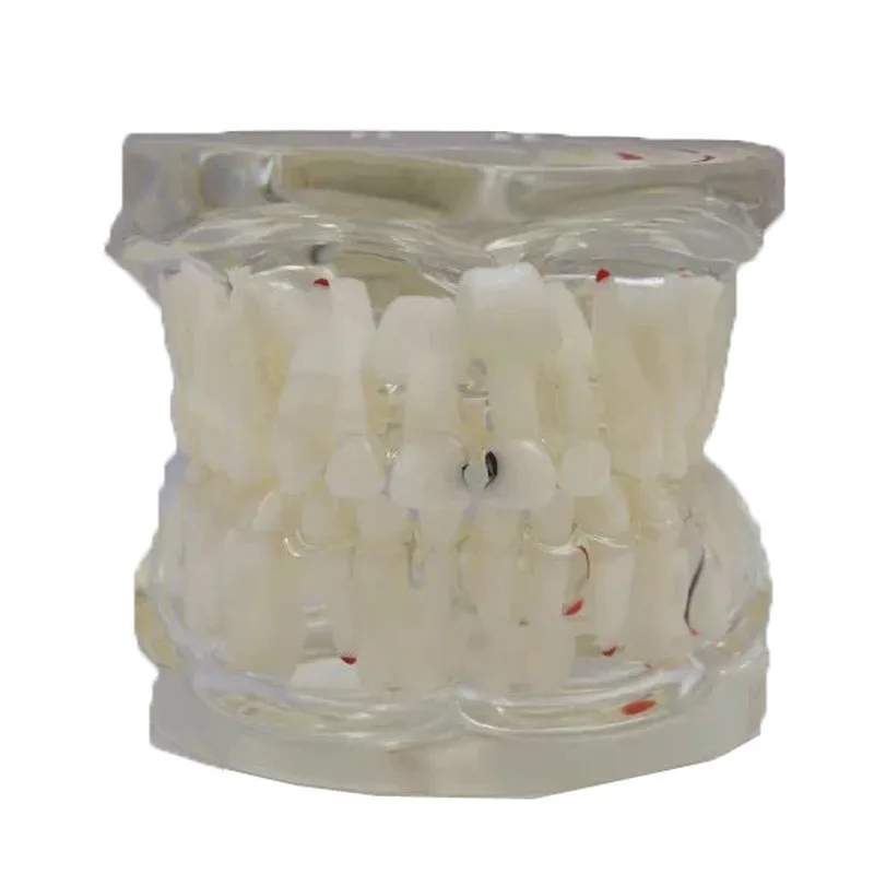 Dental Tooth Milk Permanent Teeth Alternately with Caries Teeth Model