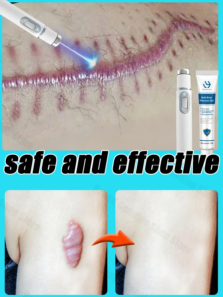 

Repair Scars Keloid Removing