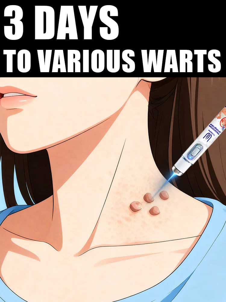 

2025 New Upgrade Blue Laser Solve Wart Tool