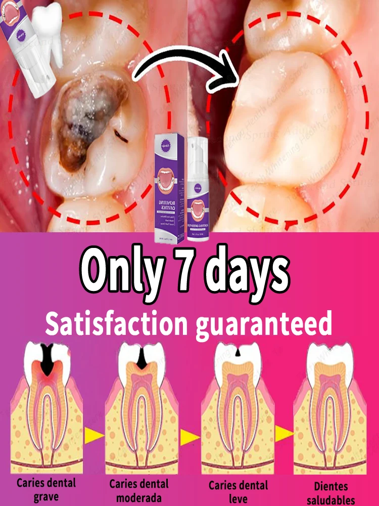 

decay Tooth Repair Repairing Cavities Protect Anti caries