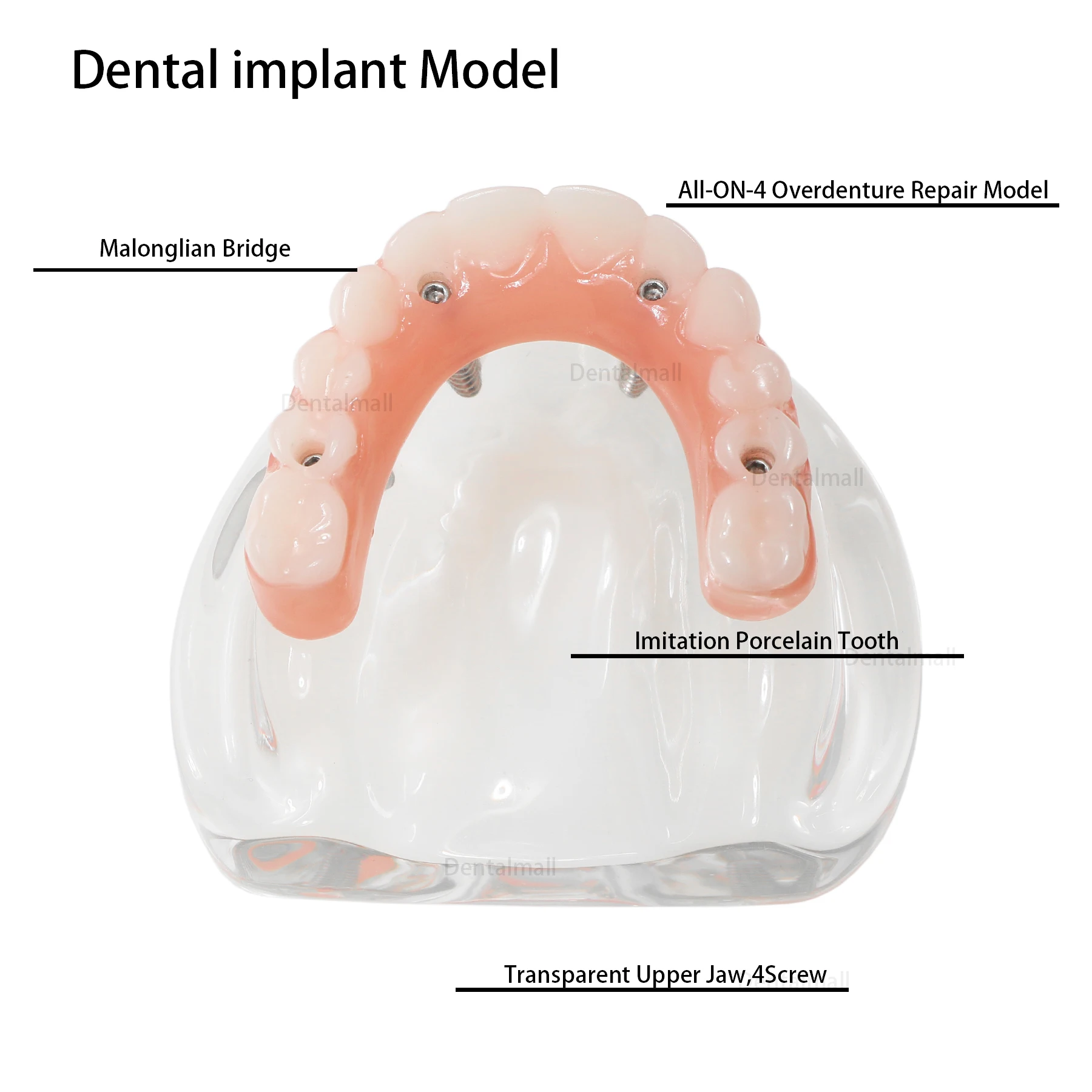 Teeth Model All-on-4 Dental Implant Model Overdenture Upper Jaw 4 Implant Clear Detachable M6001-1