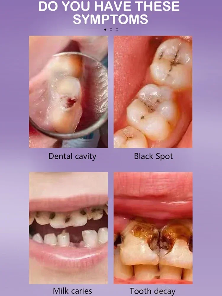 Reparación de caries dentales, reparación de todas las cavidades de caries y protección de blanqueamiento dental, corrección de color