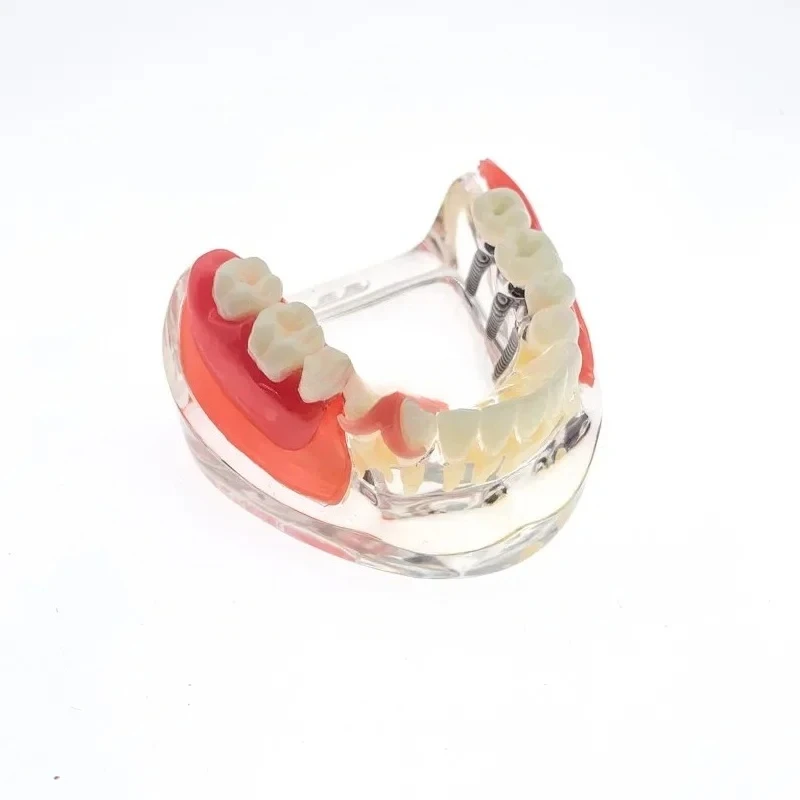 

Dentals RestorationTeeth Model Overdenture Removable Bridge Denture Demo