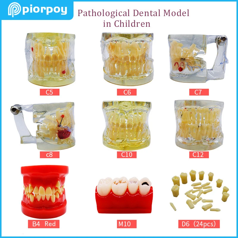 Dental Pathological Typodont Teeth Mold Periodontics Endodontic Caries Children Dentistry Teaching Student Studying Teeth Model