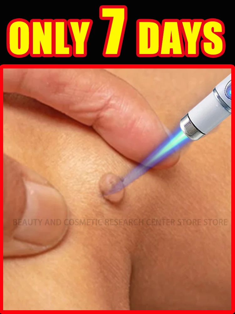 2025 new blue light tool, warts wither quickly and safely without leaving marks