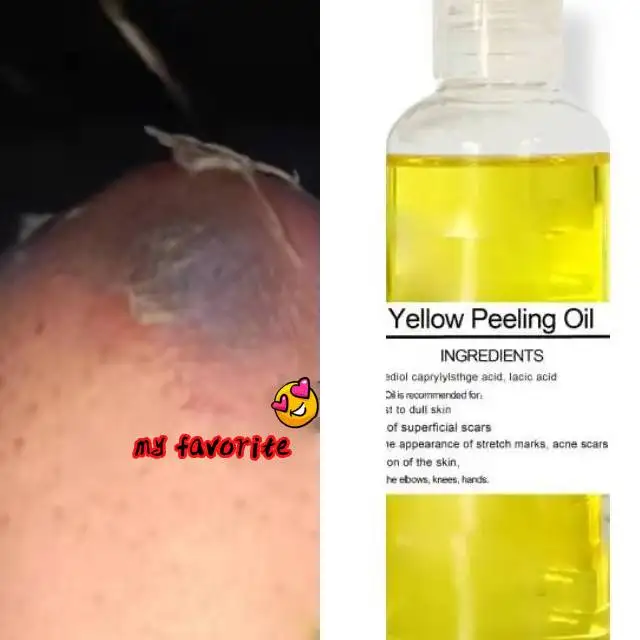 Huile de peeling jaune extra forte, traitement pour Wiltshire, visage, corps, éclaircissant, ati elles, blanchissant, jambes, blanchissant, genoux