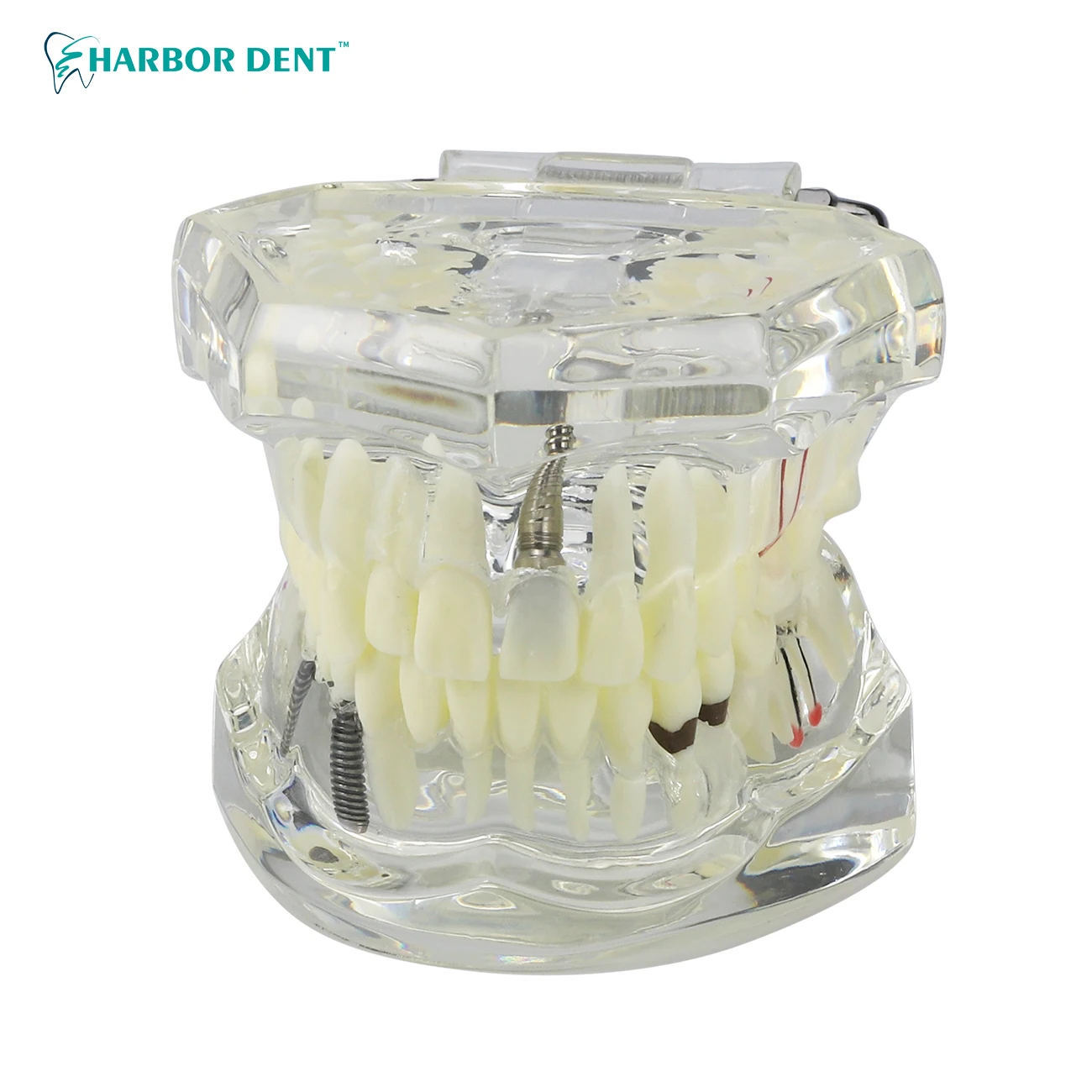 Dental Model Teeth Implant Restoration Bridge Teaching Study Medical Science Disease Dentist Dentistry Products Dental Gift