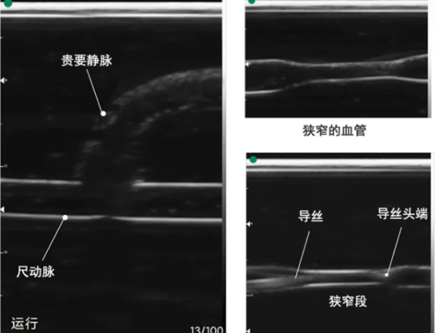 ultrasound-guided arteriovenous Pta training body model fistula anastomotic balloon dilation percutaneous transluminal angioplas