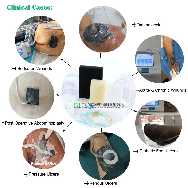 Negative pressure wound therapy dressing kit 20*10cm including black foam tubes with the pad transparent film I/Y connector