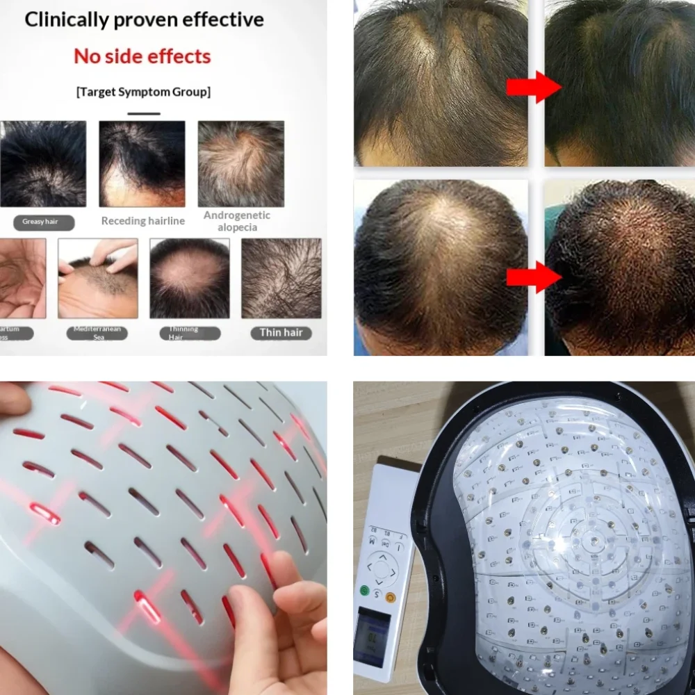 

Anti Hair Loss Laser Cap with Remote, 6750mW Max Power 90 Laser 210 LED 650/660nm, Hair Growth Helmet Adjustable for Regrowth