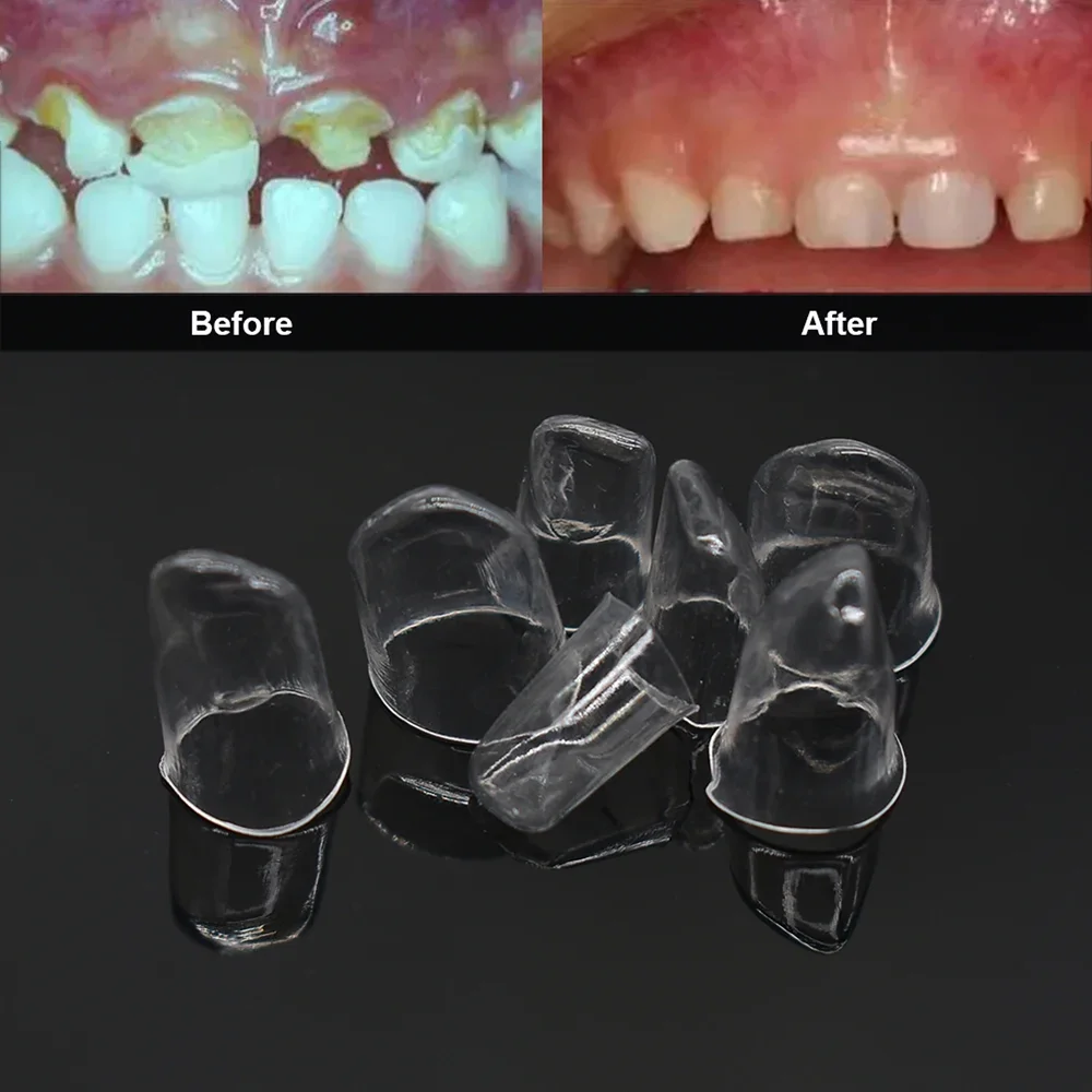 64 Peças/caixa Coroas Dentária - Whitening Teeth Dentist avaliação e preço