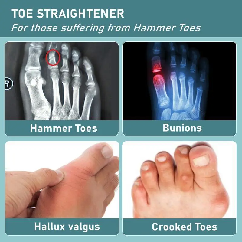 Adjustable Hammer Toe Straightener and Corrector for Metatarsalgia Claw Toe Mallet Toe Pain Relief Splint Foot Compression Wrap