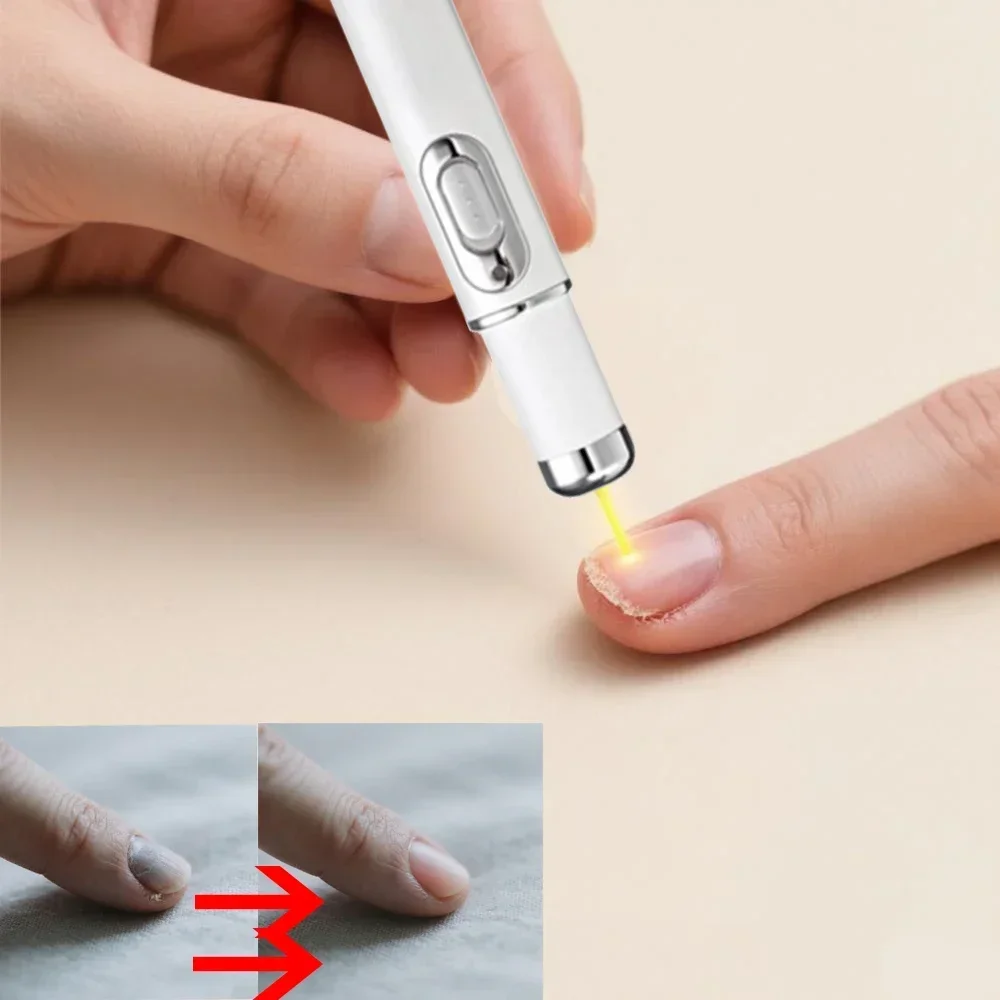 Stylo de REparation de soin des champignons، مضاد لوميريه، صب لونيشياكوز، إليimination indolore، جل، منتجات دي