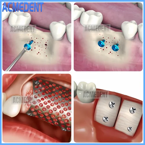 Imagen 2 del producto Tornillo Dental GBR para tienda de campaña, tornillo de media rosca para tienda de campaña, punta de mango Universal, guía de destornillador, membrana de regeneración ósea de 7/8/10mm