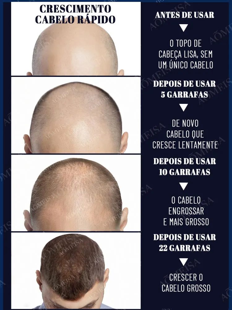 El aceite esencial para el crecimiento del cabello Angel Blue es el mejor regalo de Dios para las personas calvas, eliminando el problema de la