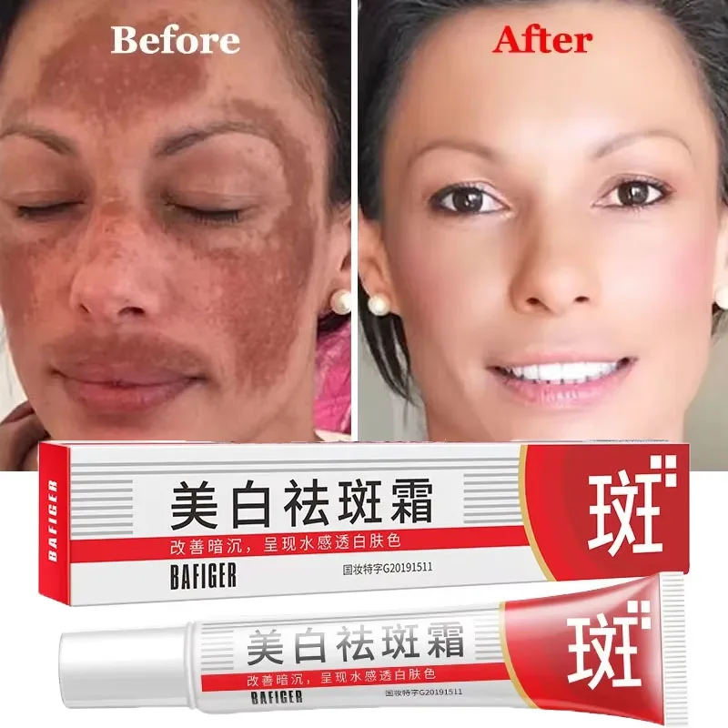 

Whitening Freckles Cream Removal Melasma Acne Scars Dark Spots Corrector Fade Melanin Pigmentation Brighten Anti-Aging Skin Care