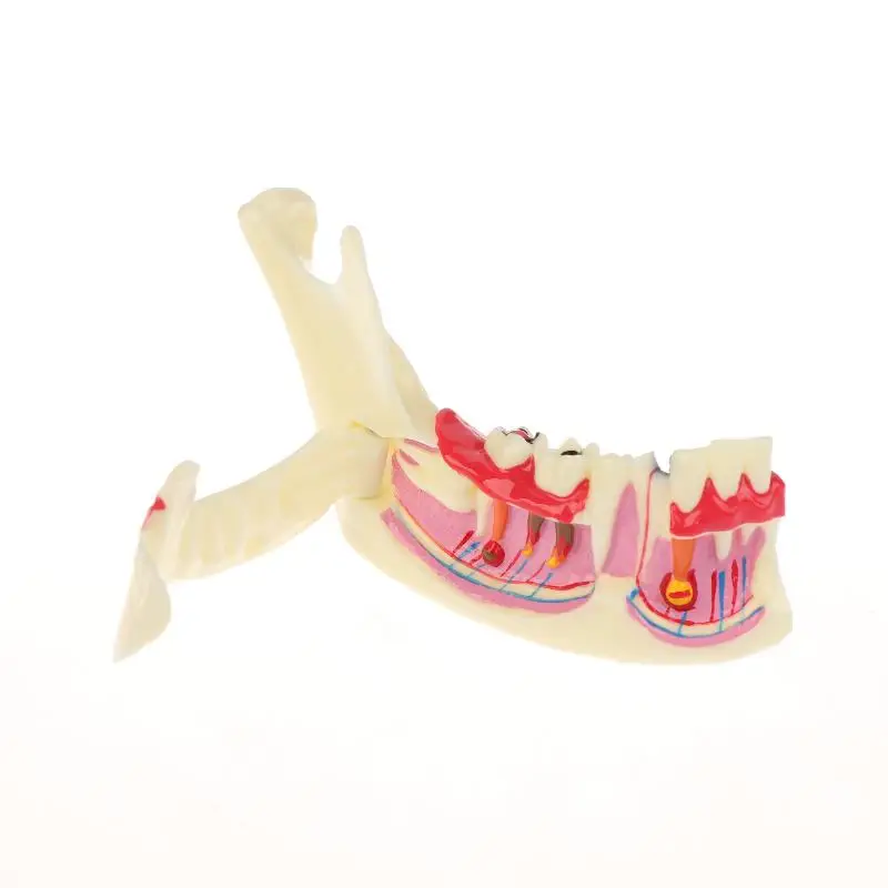 Modelo anatômico de tratamento endodôntico dental, tecido mandíbula de goma para dentista, ensino, estudo, modelo de dentes de demonstração