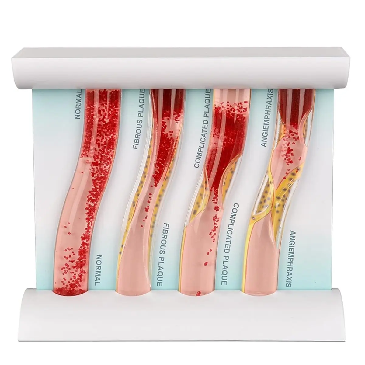 DT38 LDL Cholesterol Blood Vessel Model, 4-Stage Vascular Disease Teaching and Training Tool