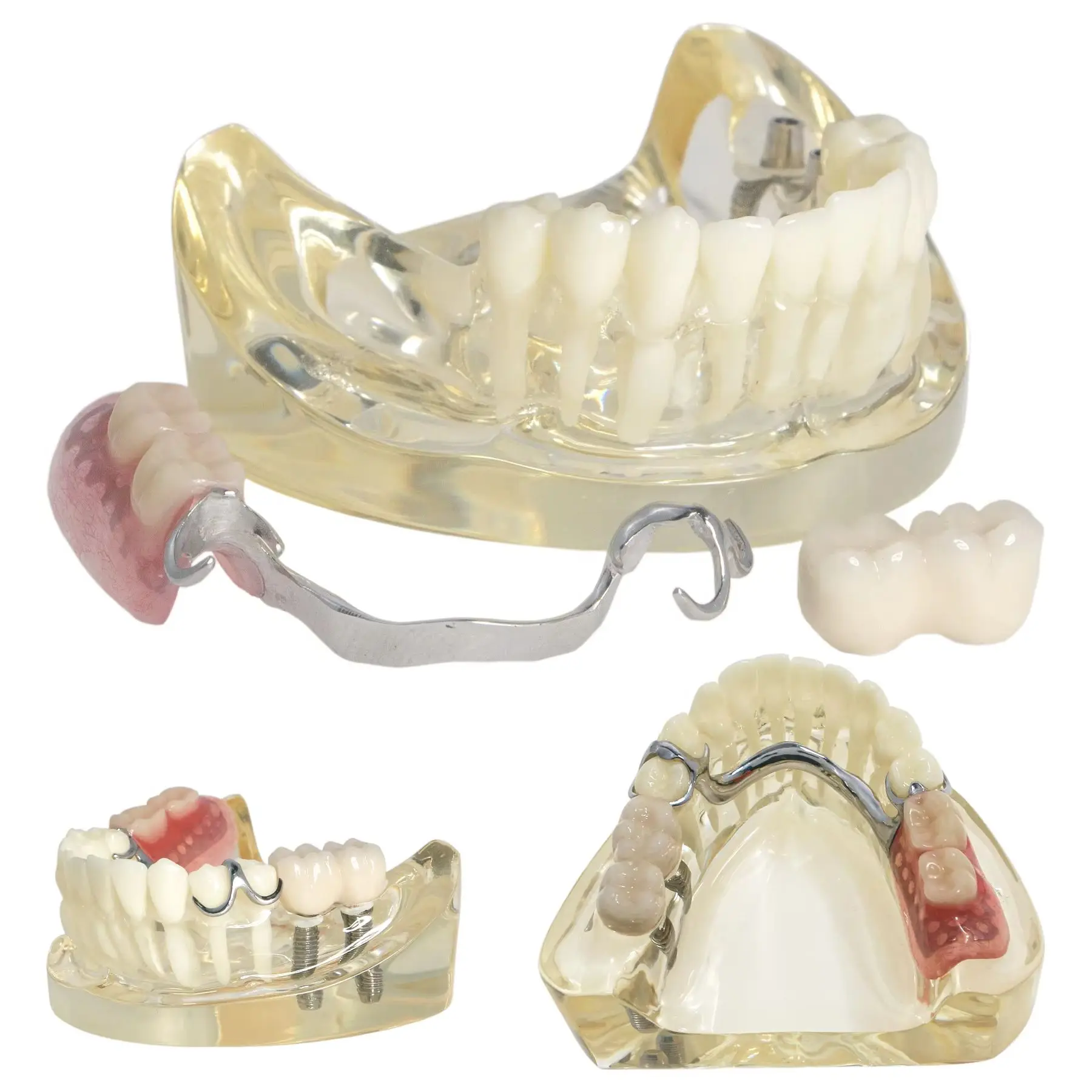 

Teeth Model Typodont Restoration Model Steel Bracket Model with Partial Denture Demo 2 Implants