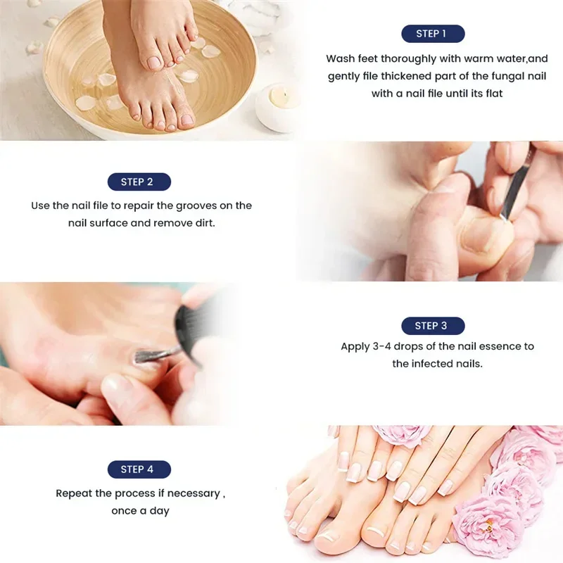 Fungal Nail Treatment Serum Foot Nail Fungus Removal Repair Gel Anti Infection Paronychia Onychomycosis Foot Nails Care Essence