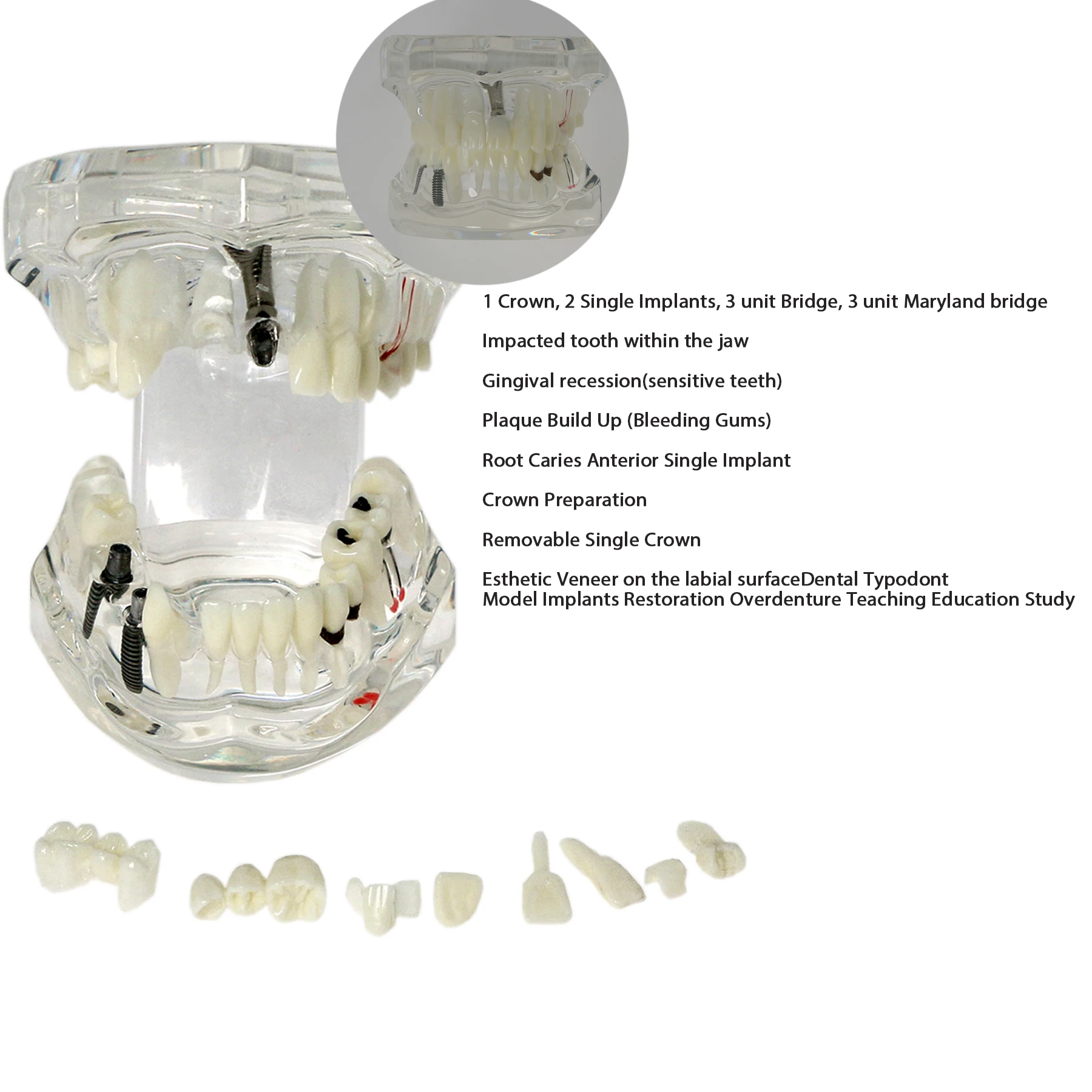 

Dental Implant Pathological Teaching Model of Diseased TeethTransparent Removable Tooth M2001C