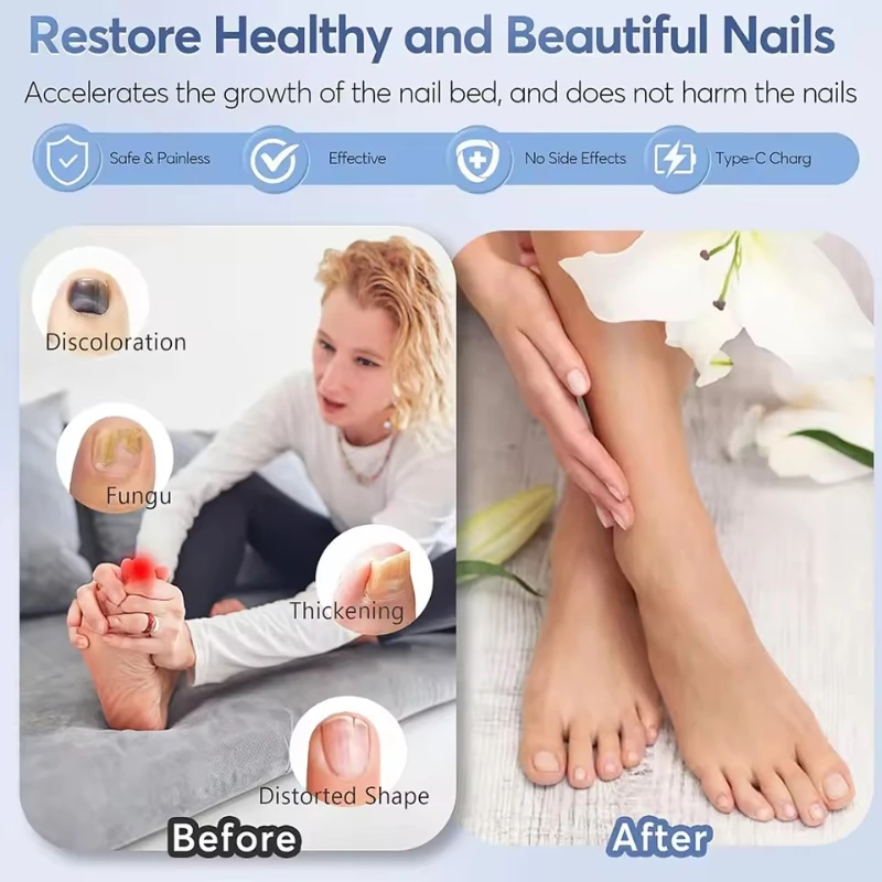 

Laser Nail Fungus Remover - Professional Onychomycosis Treatment Device for Healthy Nails