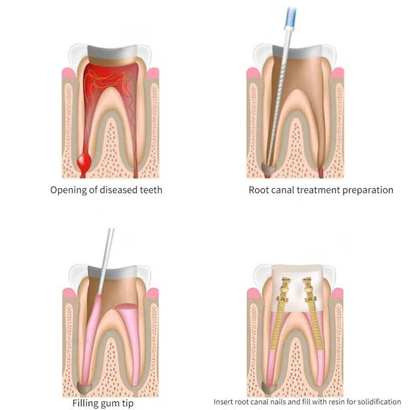 Ze stali nierdzewnej dentystyczne endodontyczne stożkowe wkręty stomatologiczne Endo kanałowe czysty tytan pozłacany materiał szkło kwarcowe