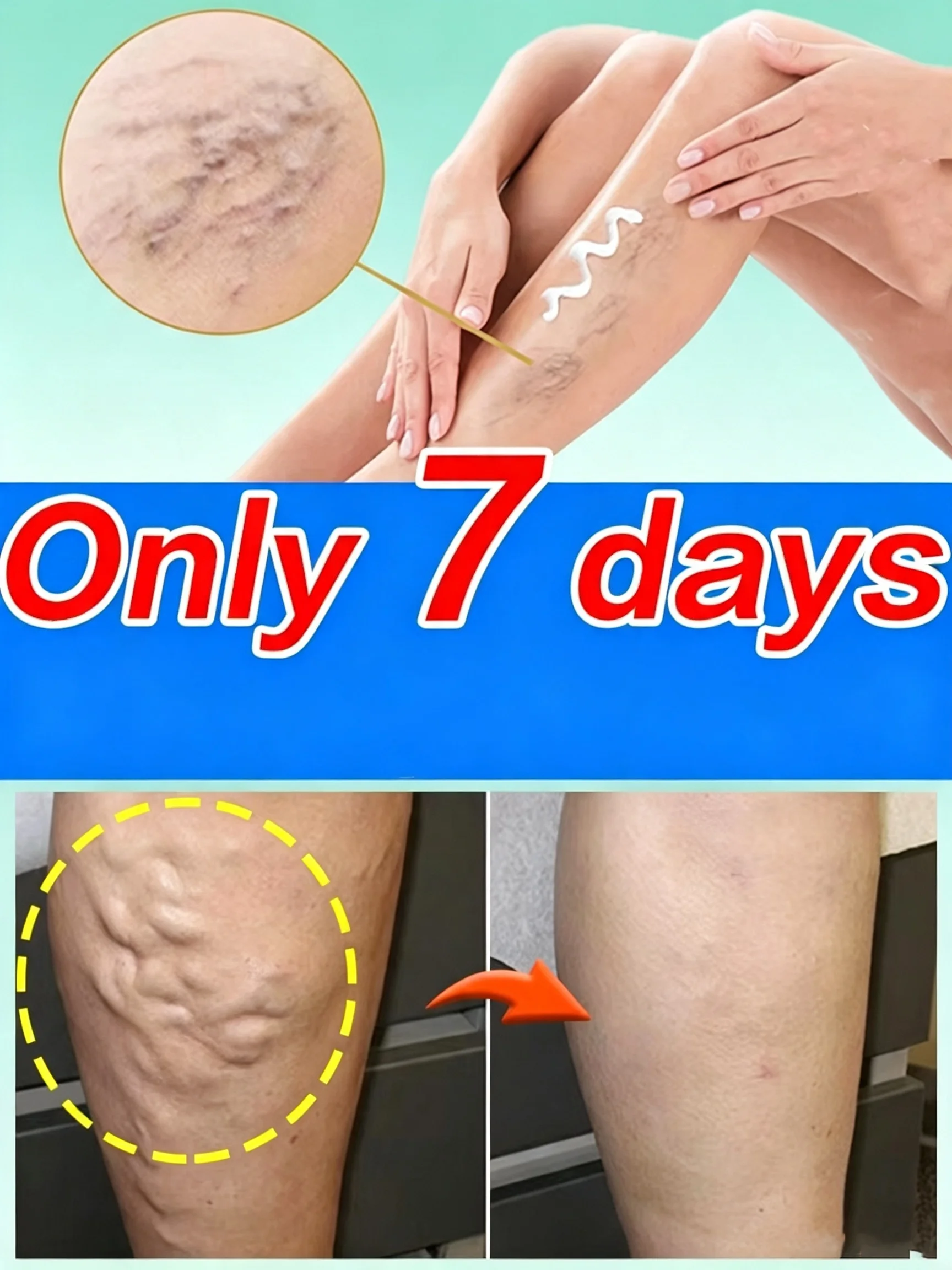 2026 Leg care Reduce Uncomfortable For Legs Improving Blood Circulation Varicose Veins Pen Skin Care Product
