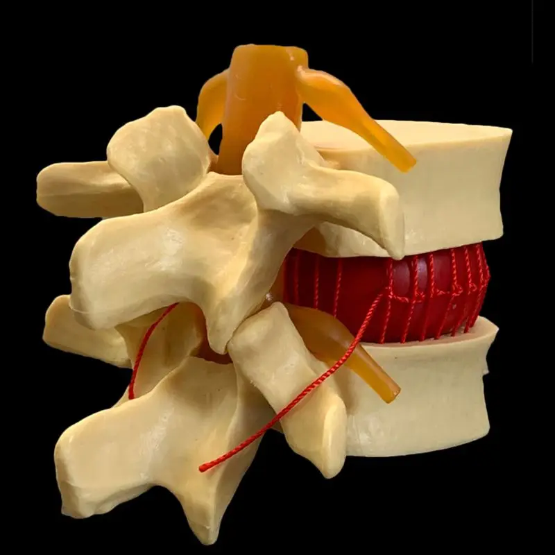 Vertebre lombari umane anatomiche modello dimostrativo di ernia del disco lombare-bianco, giallo