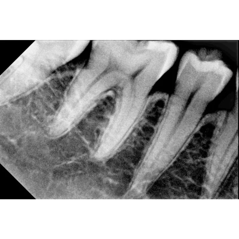 مستشعر Denta X-ray RVG المحمول من الصين الديناميكي