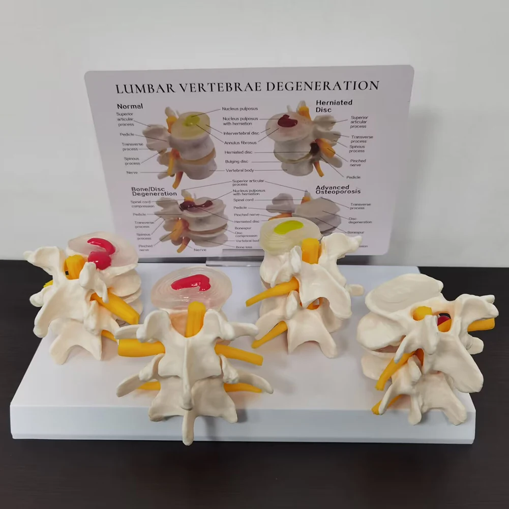 4-stage Pathological Lumbar comparative Model Bone Model For Human Body Teaching Equipment Student Lab Model Medical Teaching