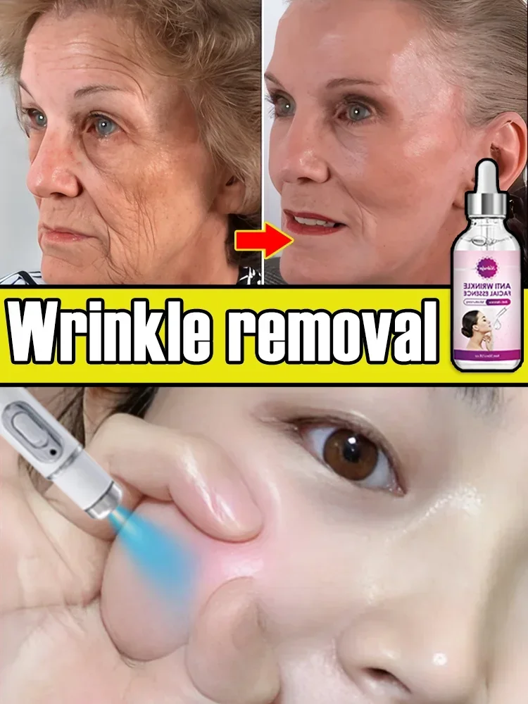 Laser Product To Solves wrinkle Problems