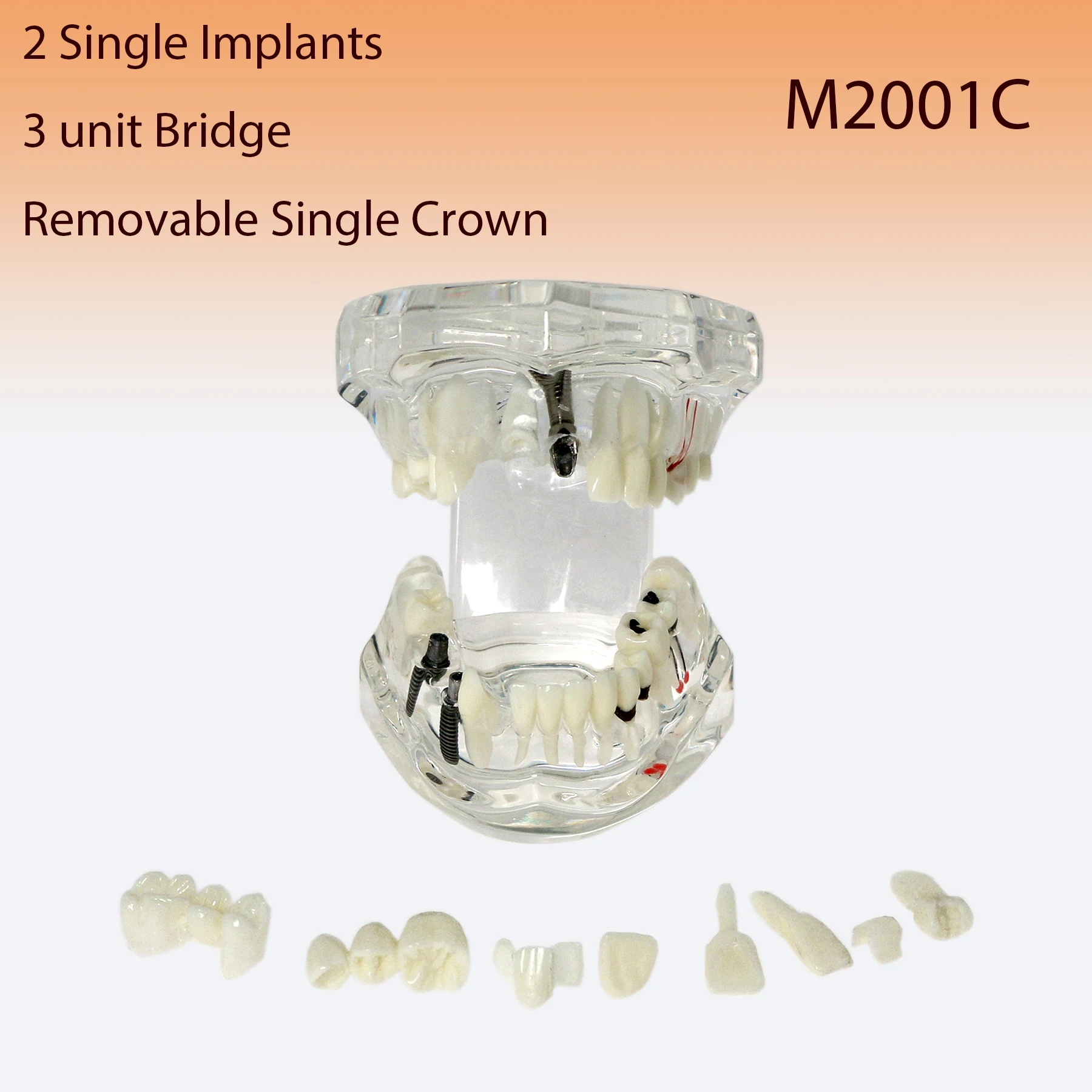Dental Teeth Model Disease Bridge Restoration Teaching Demonstration Tool M2001C for Professional Dental Education