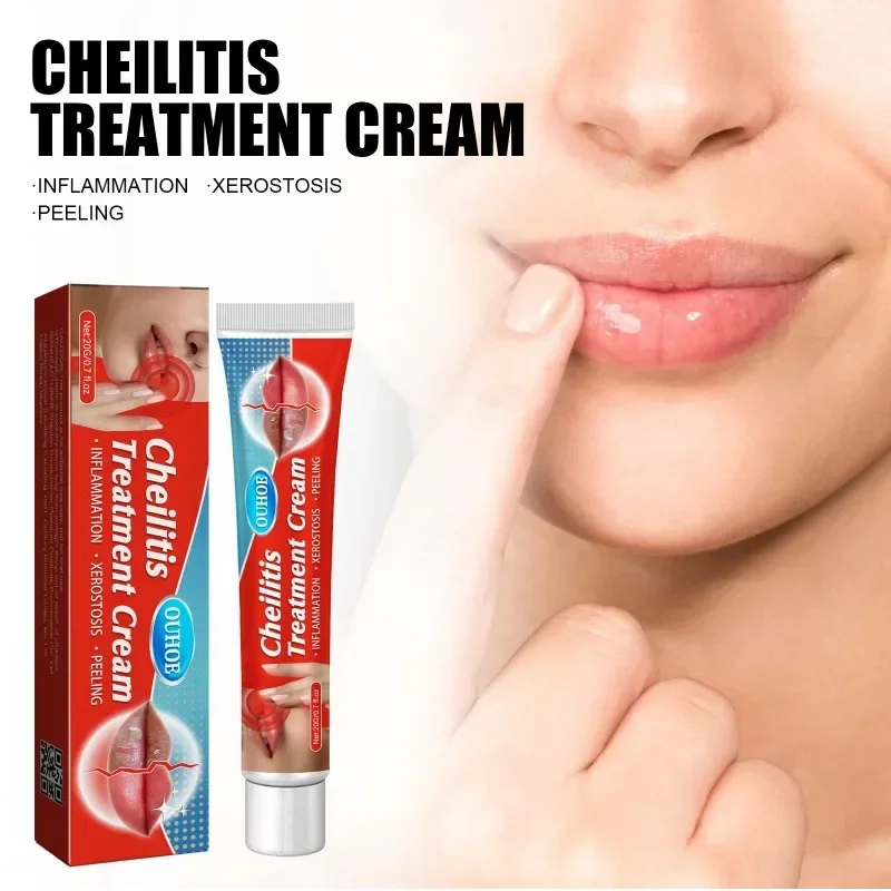 Cold Sores Lip Cheilitis Treatment Cream Herpes Antibacterials Ointment Chapped Lips Wrinkles Rehydration Plaster lip care