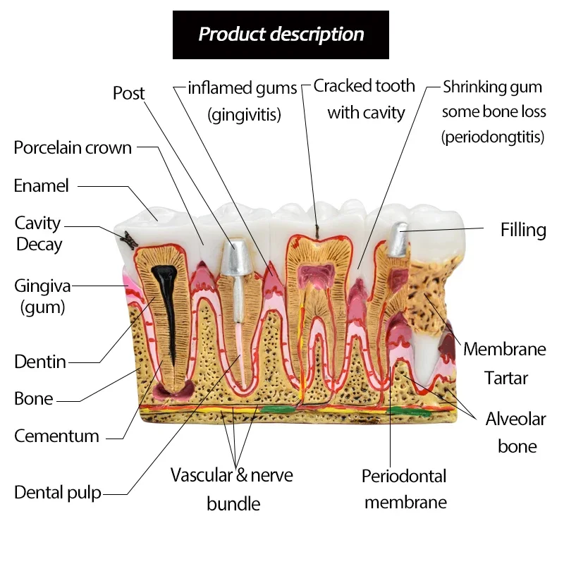 Dental Caries Anatomy Comprehensive Pathology Nerve for Oral Teaching Teeth Model