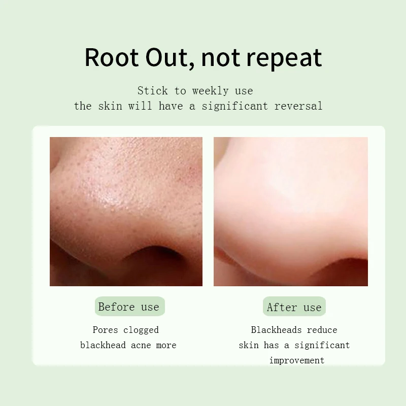 أداة إزالة الرؤوس السوداء الكهربائية البصرية لعلاج حب الشباب والبثور وإزالة الزيت والعناية الشخصية بالجمال باللون الأسود والأبيض