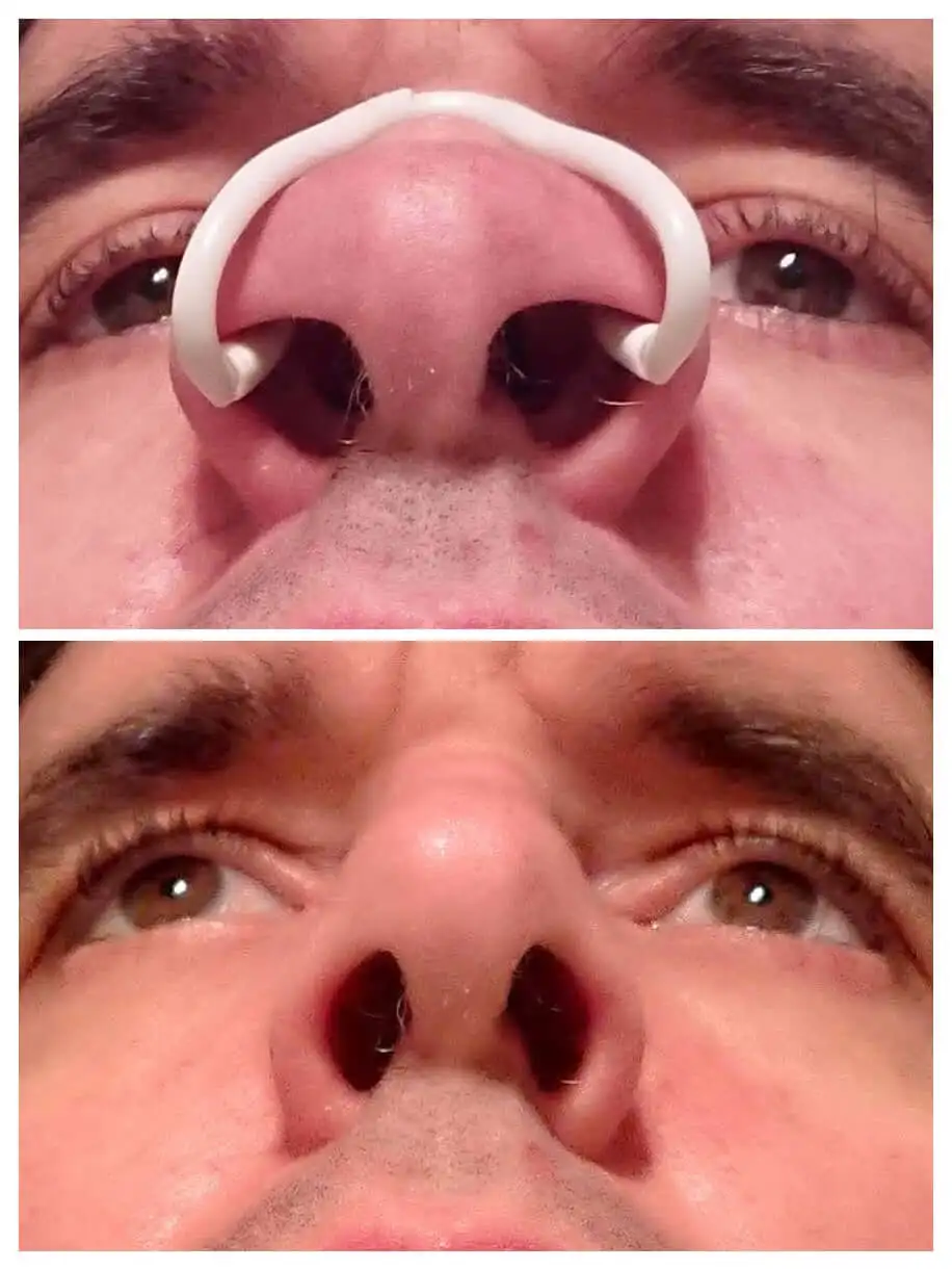 Thumbnail 4 - #55 Compare Snoring & Sleep Apnea Aids Before You Buy