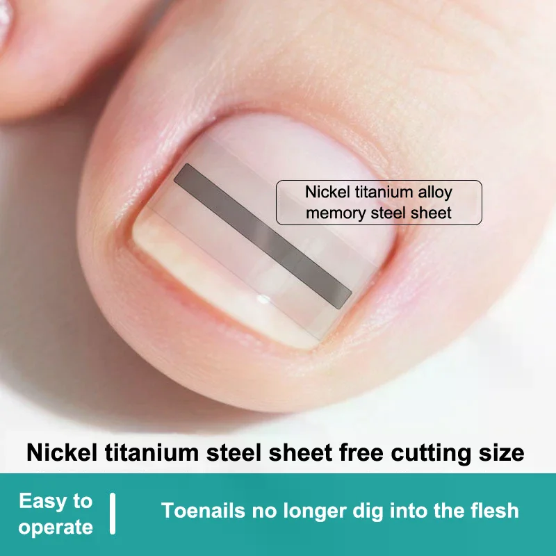 Ingrown Toenail Cor…