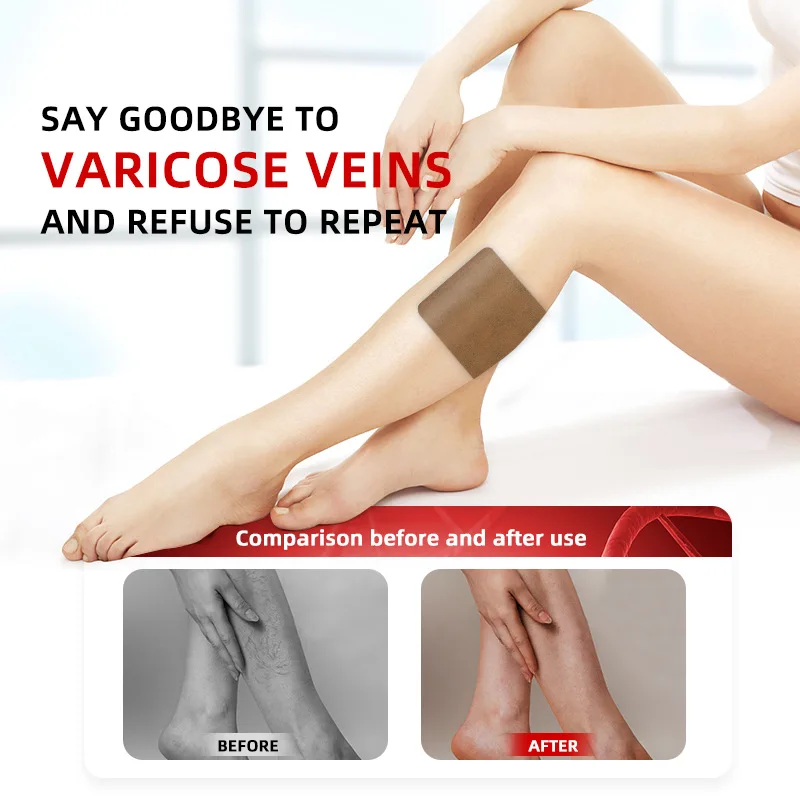 Vasculitis Phlebitis Spider Cream Varicose Veins Patch Varicosity Angiitis Ointmnet Removal Herbal Medical Plaster