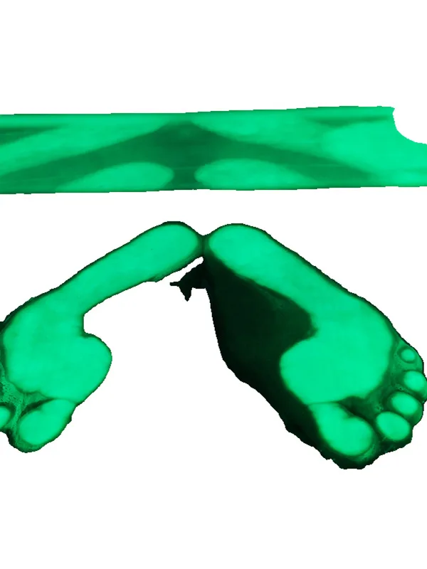 Electric optical pedicle foot correction