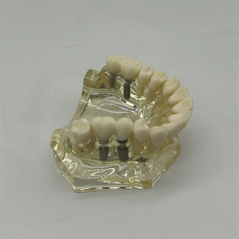 

Dental Teaching Model M2011 Implant Maxillary Model