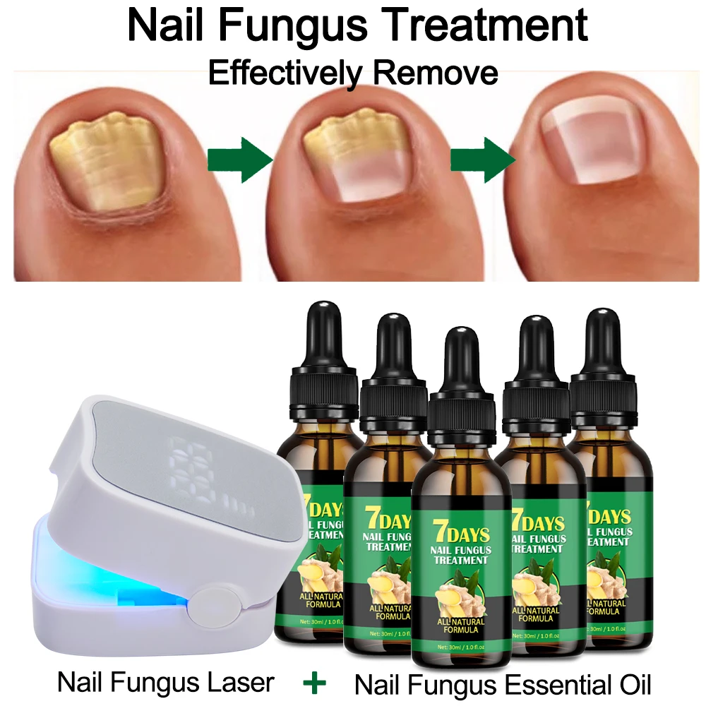 Effective Remove Fungal Nail Treatment Set Toe Nail Fungus Removal Oil + Nail Fungus Device Anti Infection Fungal Nail Removal