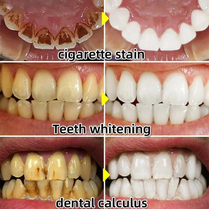 Dissolvant de calcul dentaire, blanchiment des dents, vaporisateur, livres de dentifrice, hygiène buccale, élimination de l'halitose, plaque SAF, soins pour une haleine fraîche