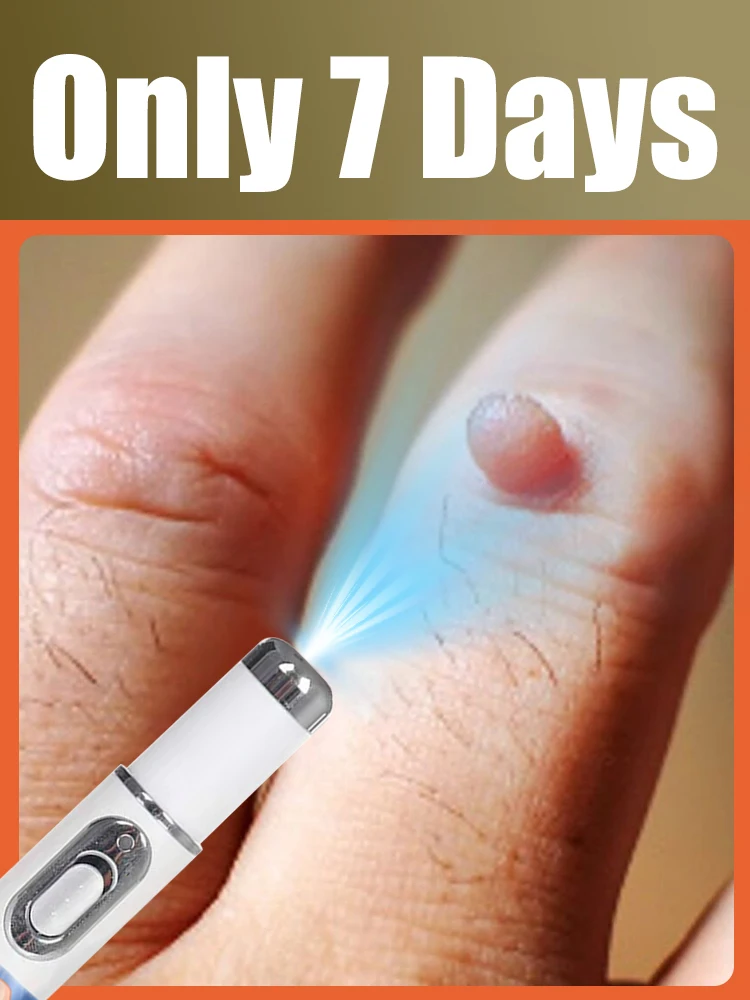 

Wart Care Helper: Blue Light Pen - Safe for Home Use, Simple to Handle