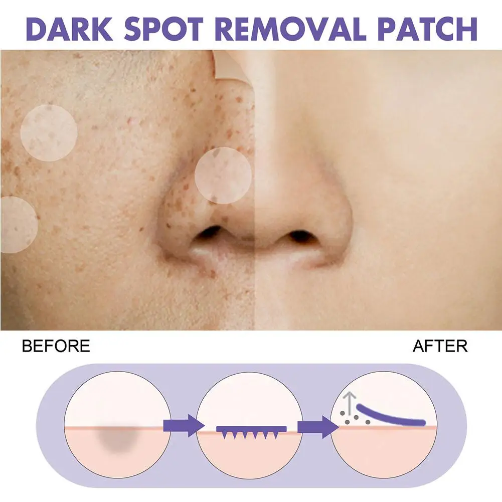 Dark S-pot Removal Patch Freckles Blackhead Remover Shrink Pores Cleansing Lightening Melanin Pigment Cover Marks Pimple Patch
